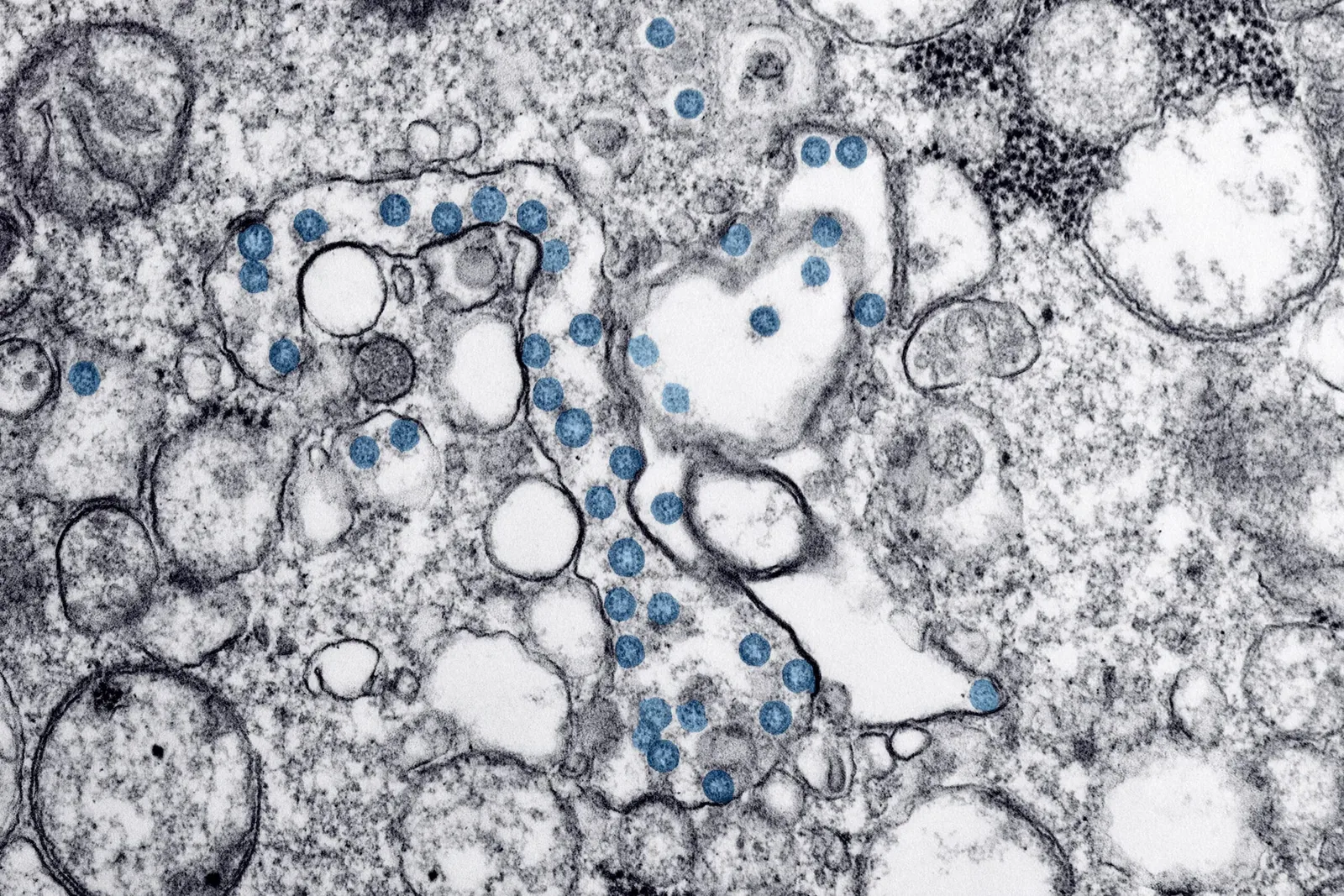 Genetiske funn fra chilenske mumier bekrefter europeisk koppsmittetilkomst