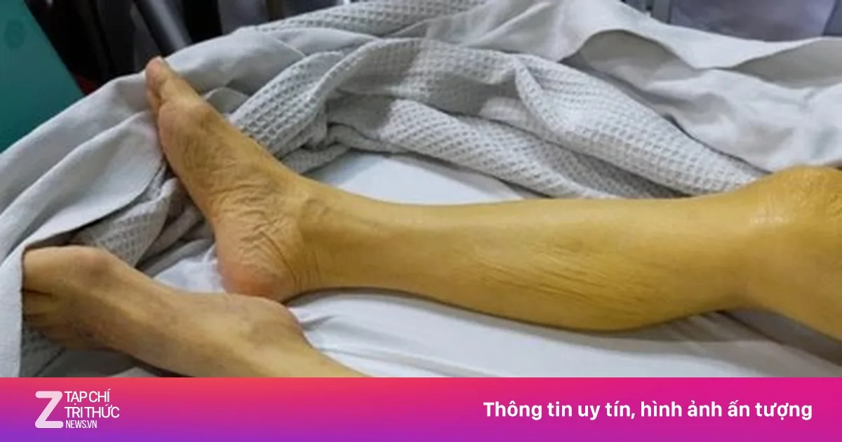 6,5 millioner vietnamesere har hepatitt B: Viktige råd