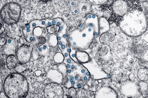 Genetiske funn fra chilenske mumier bekrefter europeisk koppsmittetilkomst